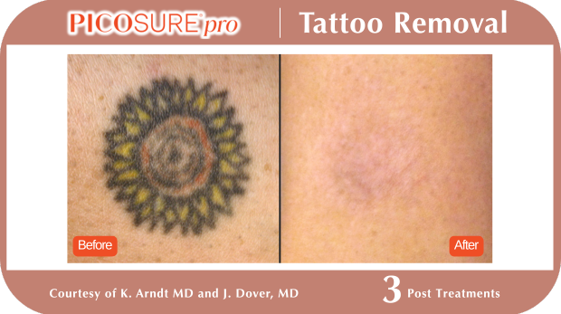 PicoSure Tattoo Removal PicoSure Tattoo Removal