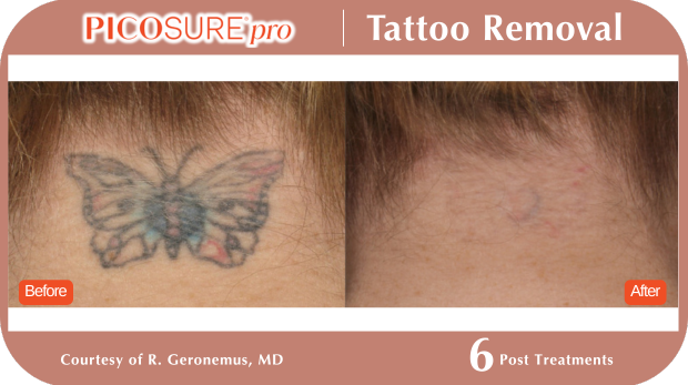 PicoSure Tattoo Removal PicoSure Tattoo Removal