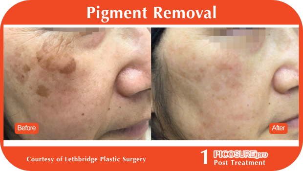 PicoSure Pro Before and After PicoSure Pro Before and After
