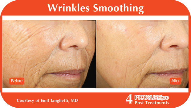 PicoSure Pro Before and After PicoSure Pro Before and After