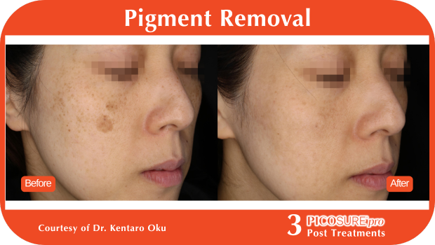 PicoSure Pro Before and After PicoSure Pro Before and After