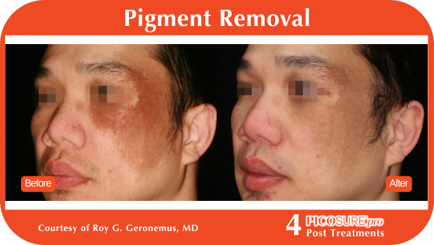 PicoSure Pro Before and After PicoSure Pro Before and After