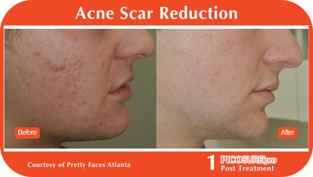 PicoSure Pro Before and After PicoSure Pro Before and After