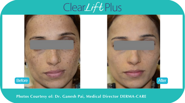 ClearLift