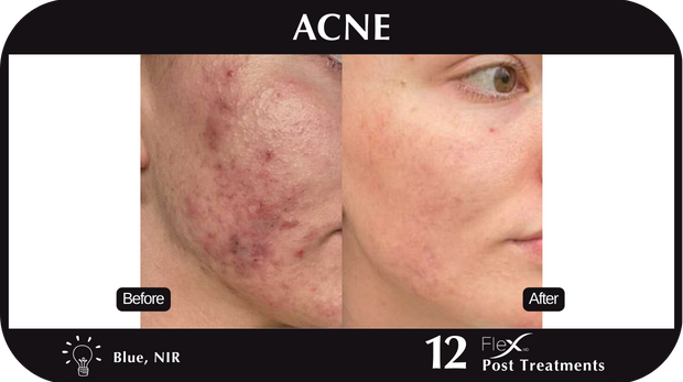 Flex MD - Acne Flex MD - Acne