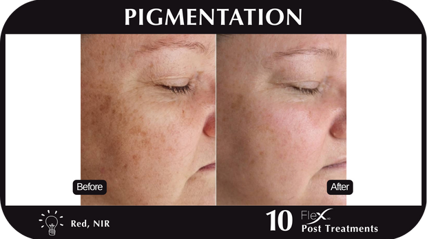 Flex MD Pigmentation Flex MD Pigmentation