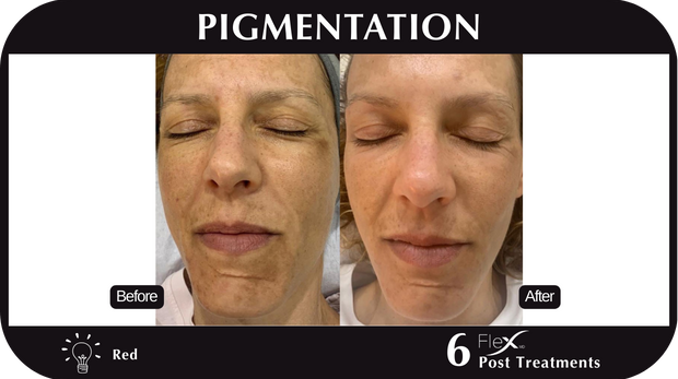 Flex MD Pigmentation Flex MD Pigmentation