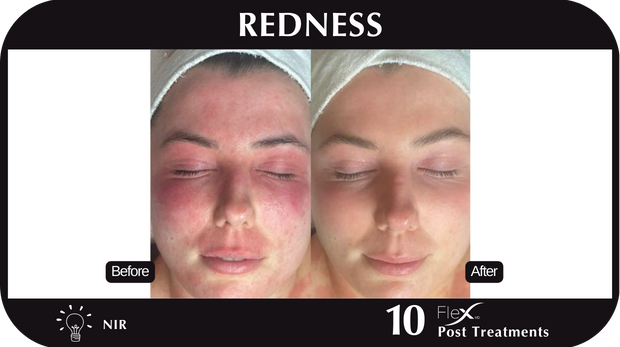 Flex MD Redness Flex MD Redness