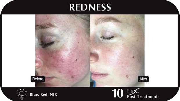 Flex MD Redness Flex MD Redness
