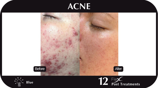 Flex MD Acne