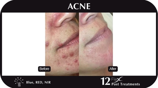 Flex MD Acne