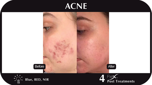 Flex MD Acne