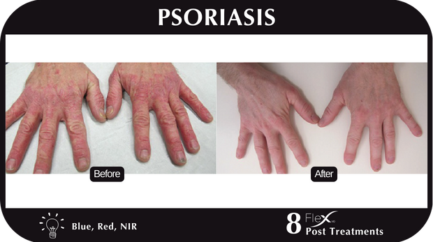 Flex MD Psoriasis