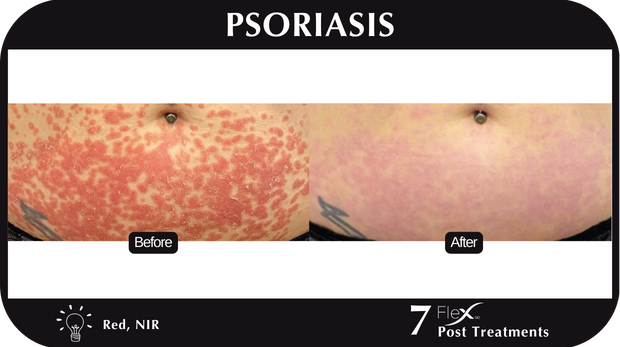 Flex MD Psoriasis