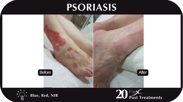 Flex MD Psoriasis