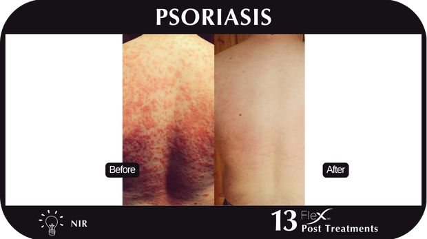 Flex MD Psoriasis