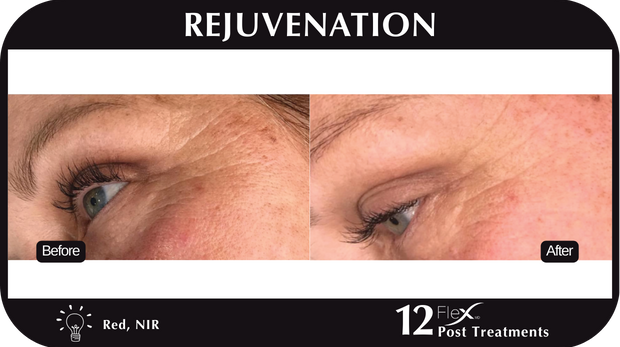 Flex MD Rejuvenation