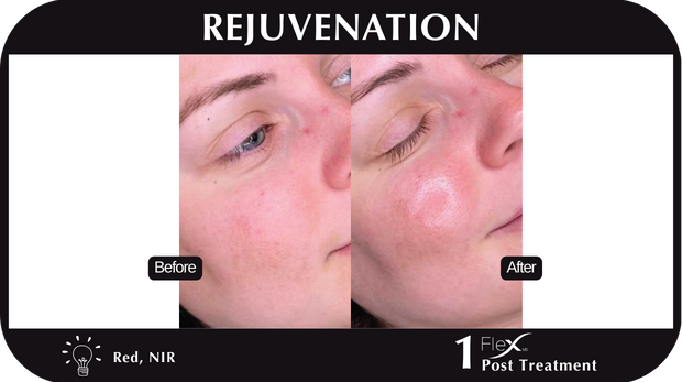 Flex MD Rejuvenation