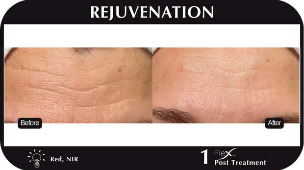 Flex MD Rejuvenation